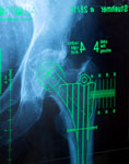 Behandlungsablauf Hüftgelenksersatz Röntgenbild