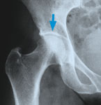 Krankheitsbild Arthrose Gesund
