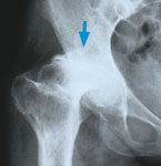 Krankheitsbild Arthrose 