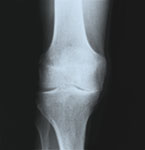 Kniegelenksersatz Kniegelenk mit Arthrose